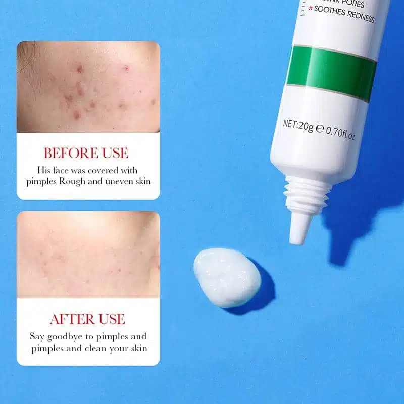 Bioaqua Salicylic Acid Acne Removal Cream – 20g